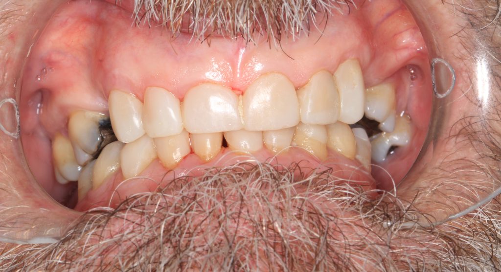 Composite Veeners After