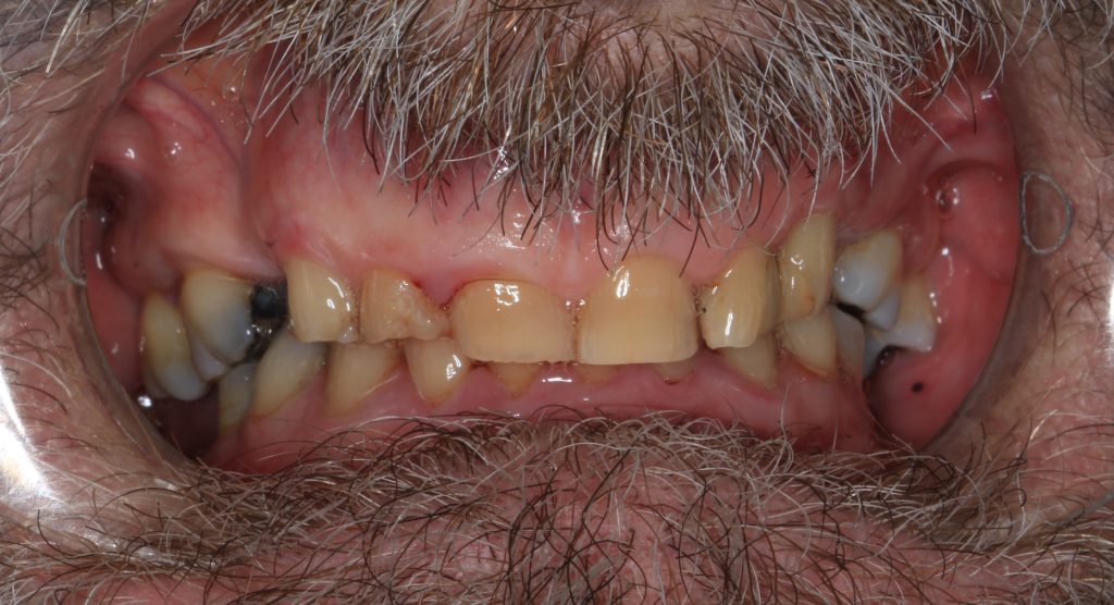 Composite Veeners Before