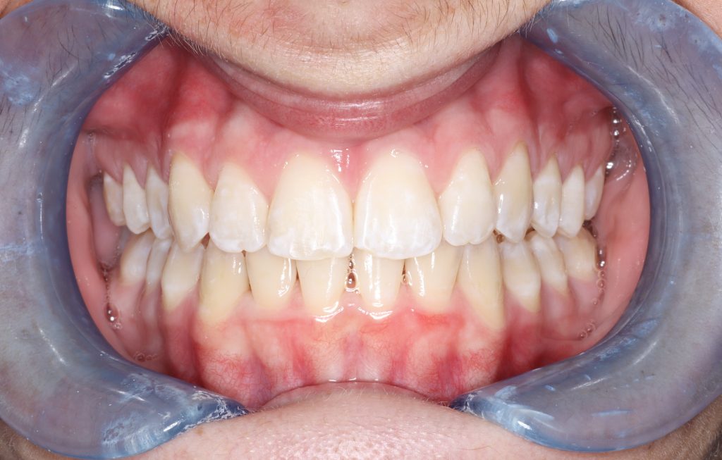 After aligners
