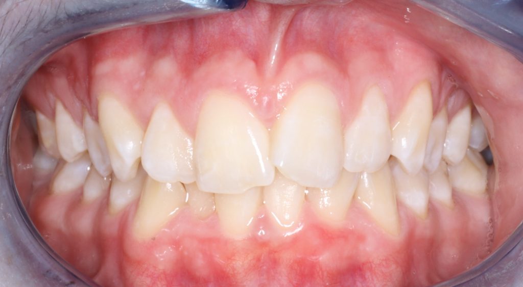 Before aligners