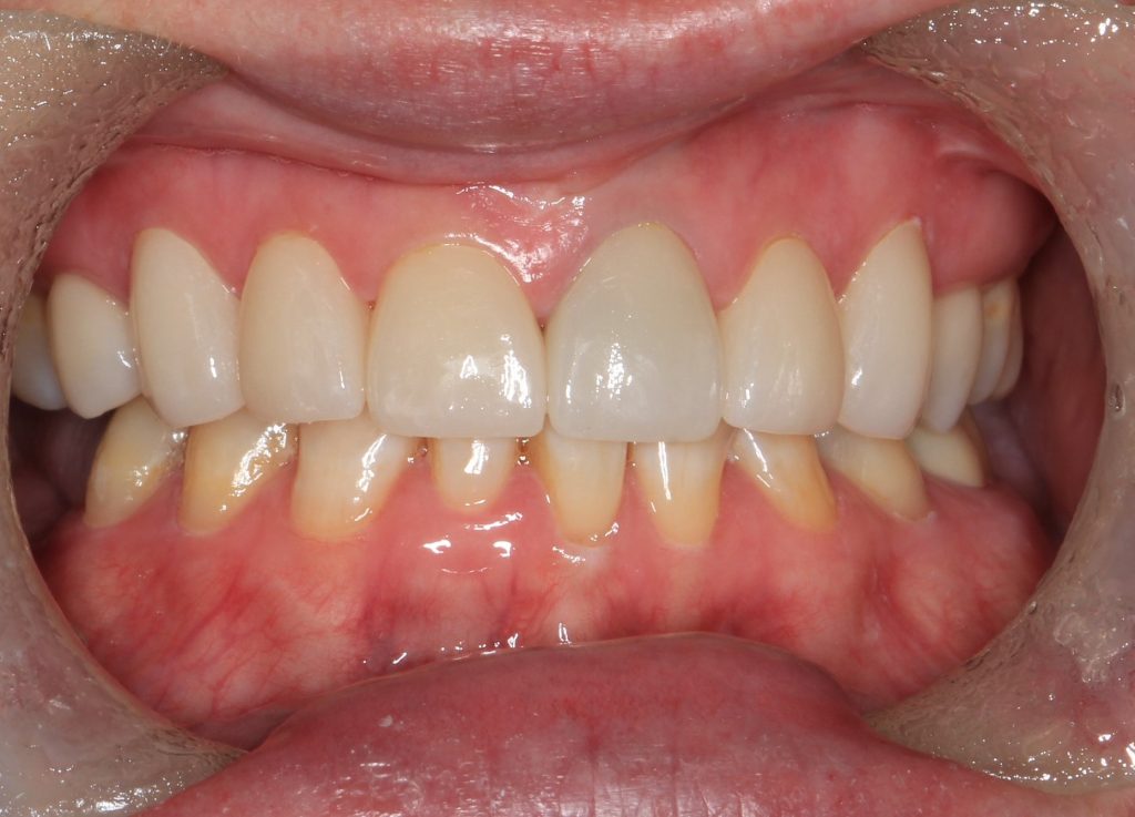 Porcelain Veneers AFTER