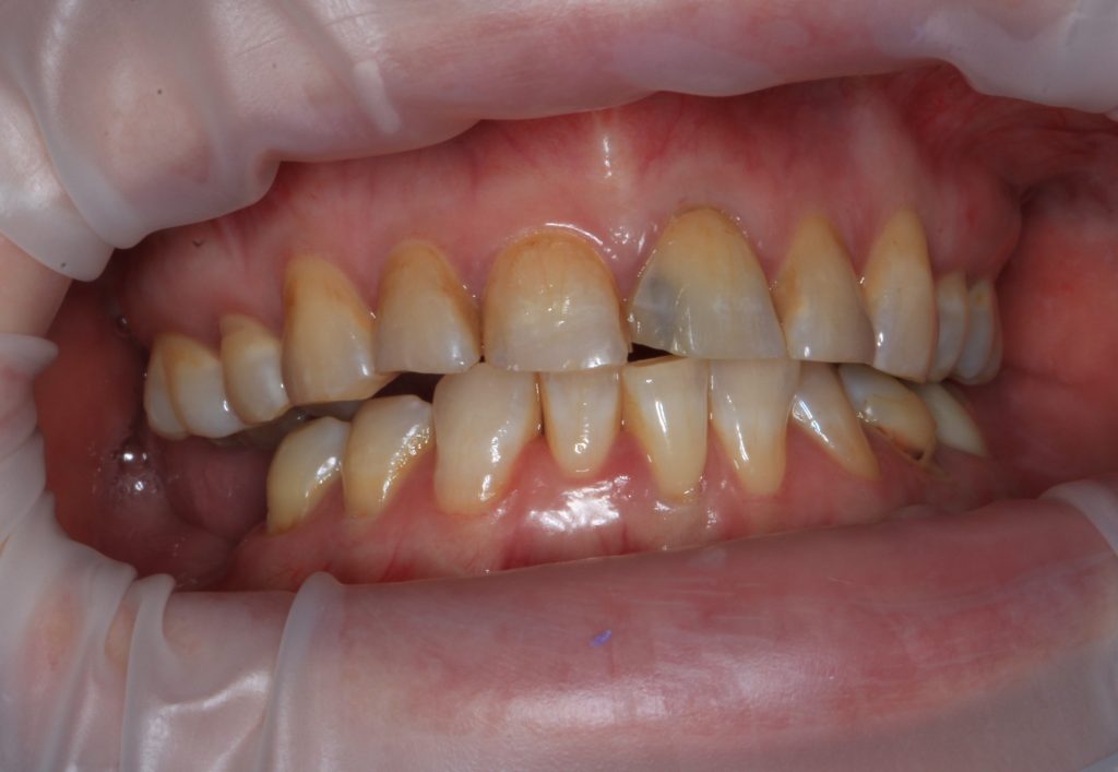 Porcelain Veneers BEFORE